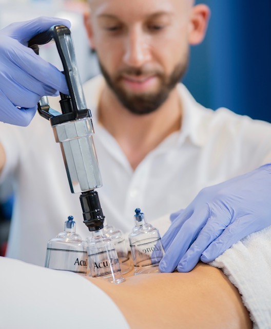 Patient receiving cupping therapy treatment