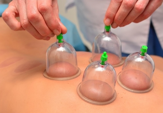 Therapist applying cupping therapy technique